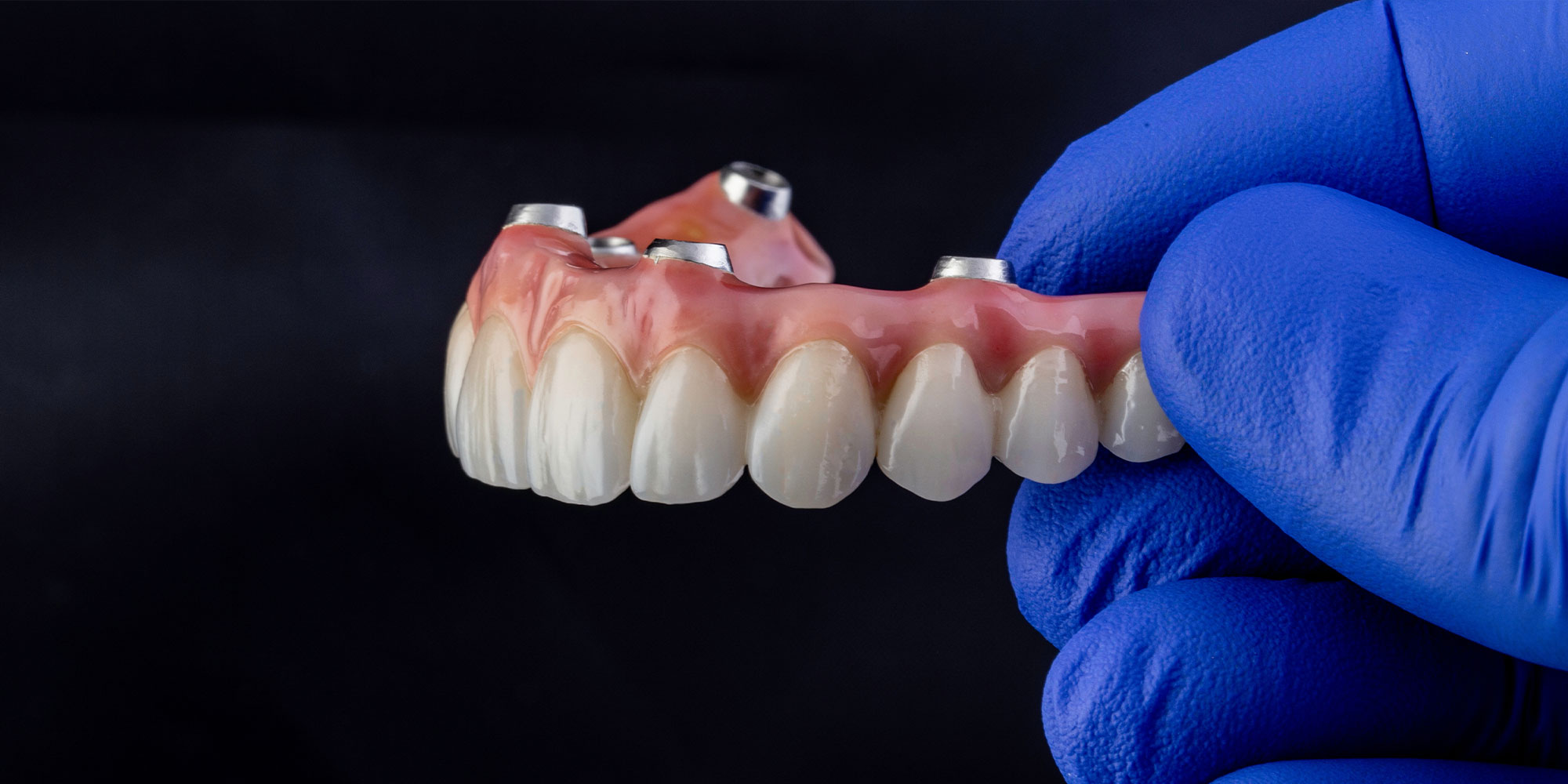 close up of dental implant full arch model